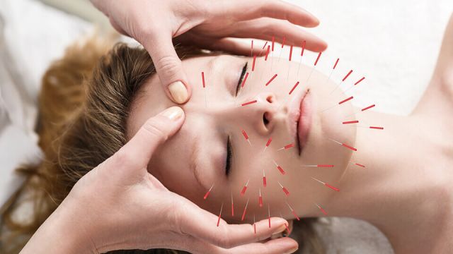 Benefits of Acupuncture